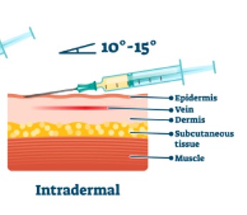 Intradermal Injection