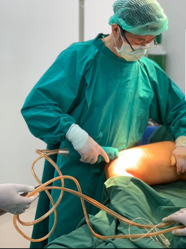 Liposuction with EVA sp 6