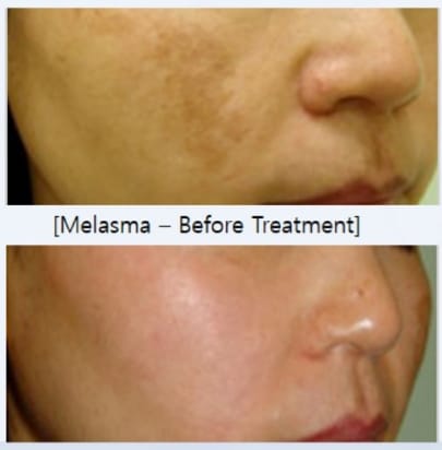 Melasma 9