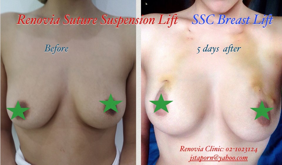 SSC Breast Lift 2