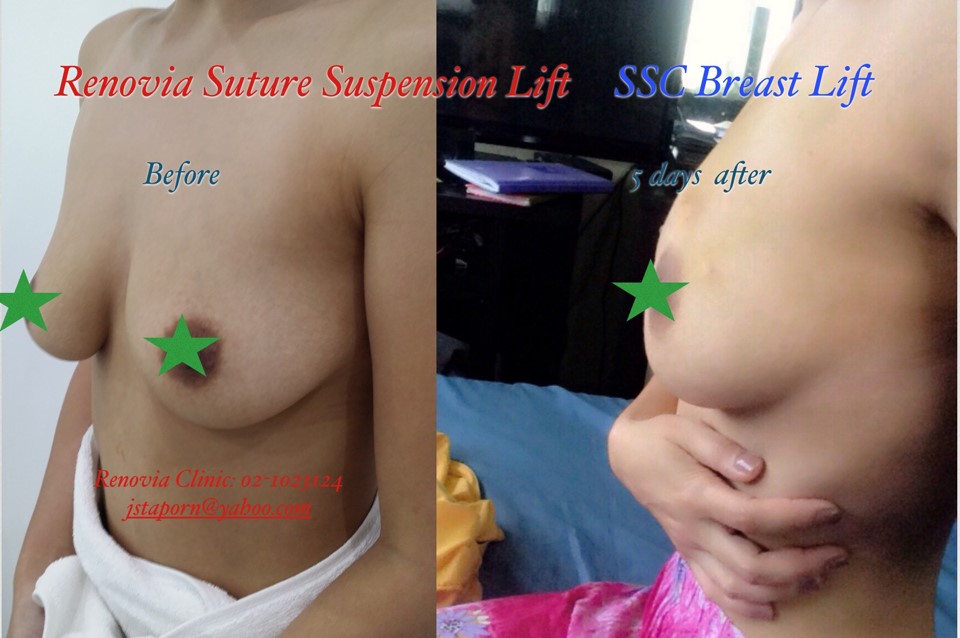 SSC Breast Lift