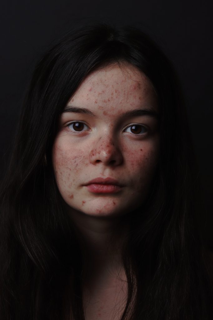 Acne Depression