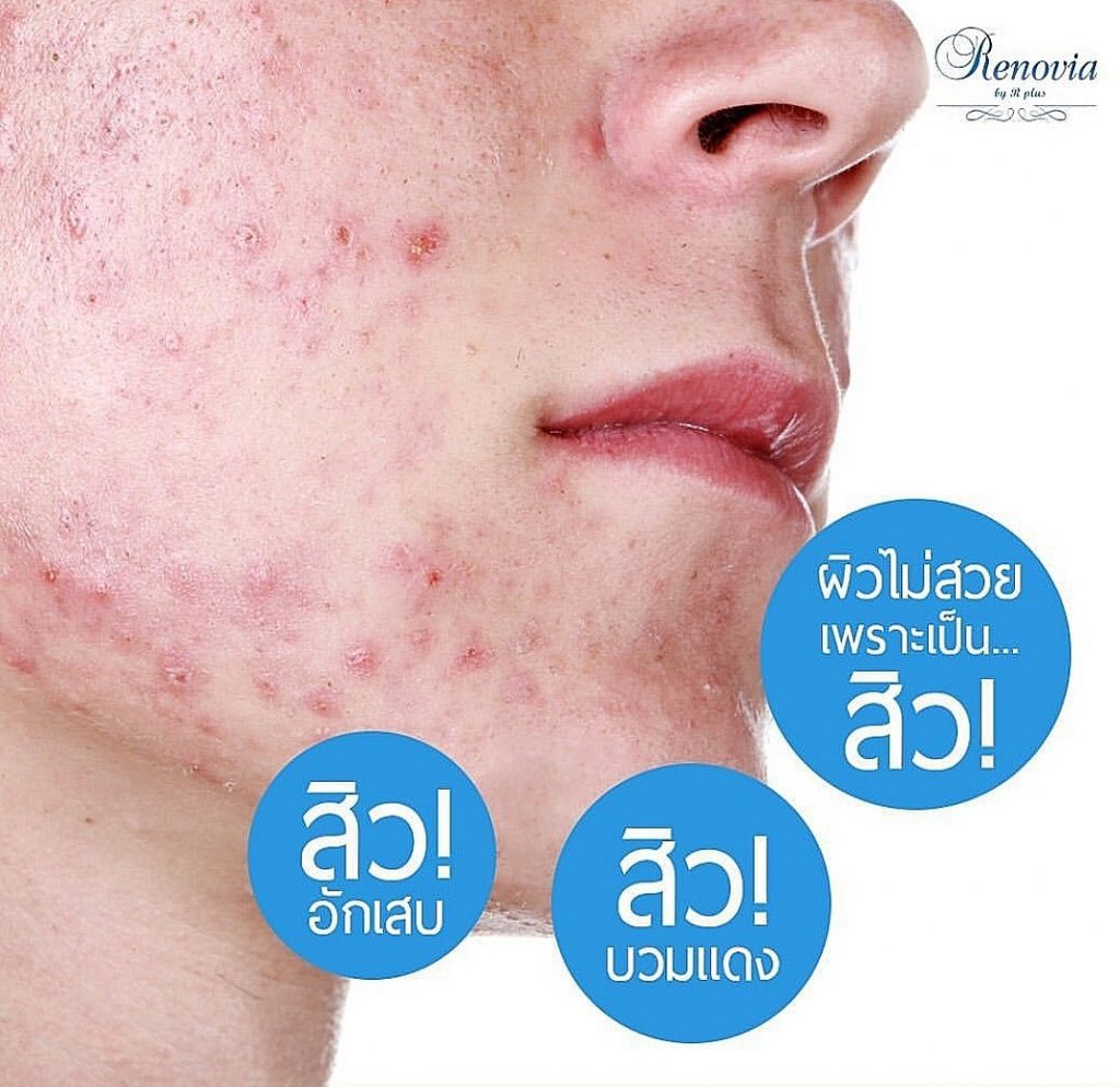 Acne PIH 2